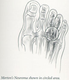 neuroma